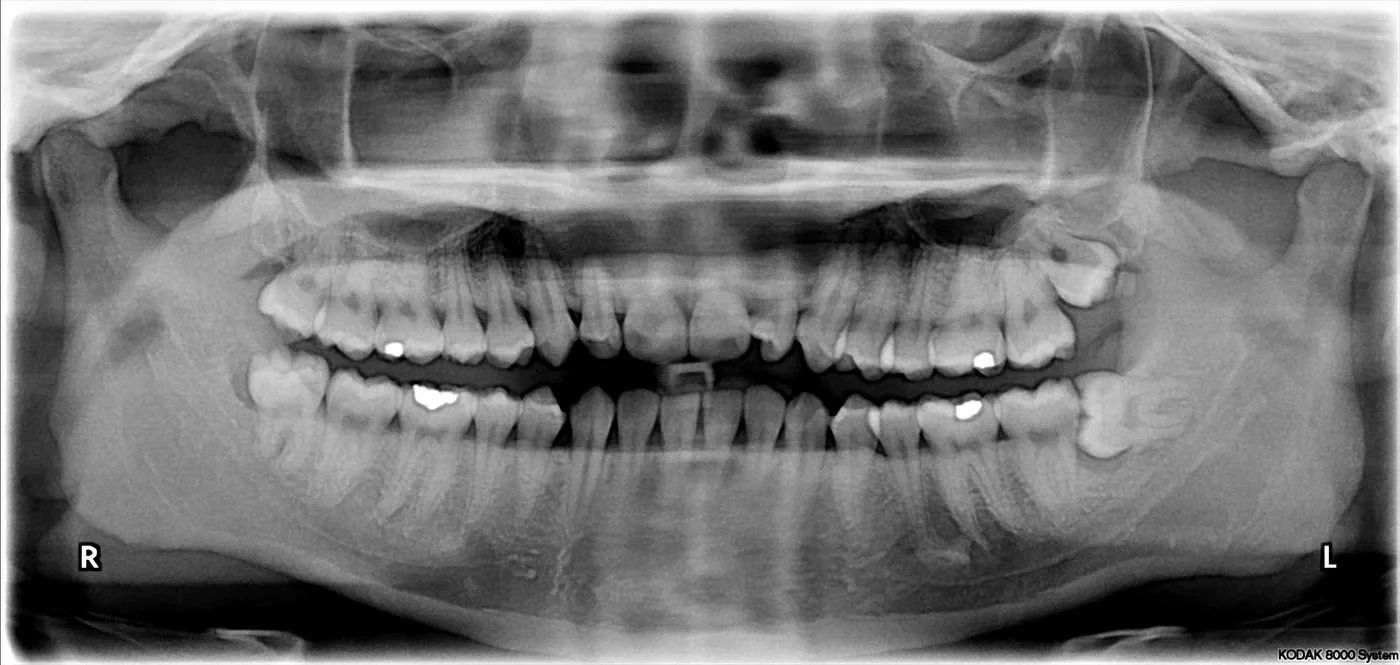 Ortopantomografía con terceros molares incluidos