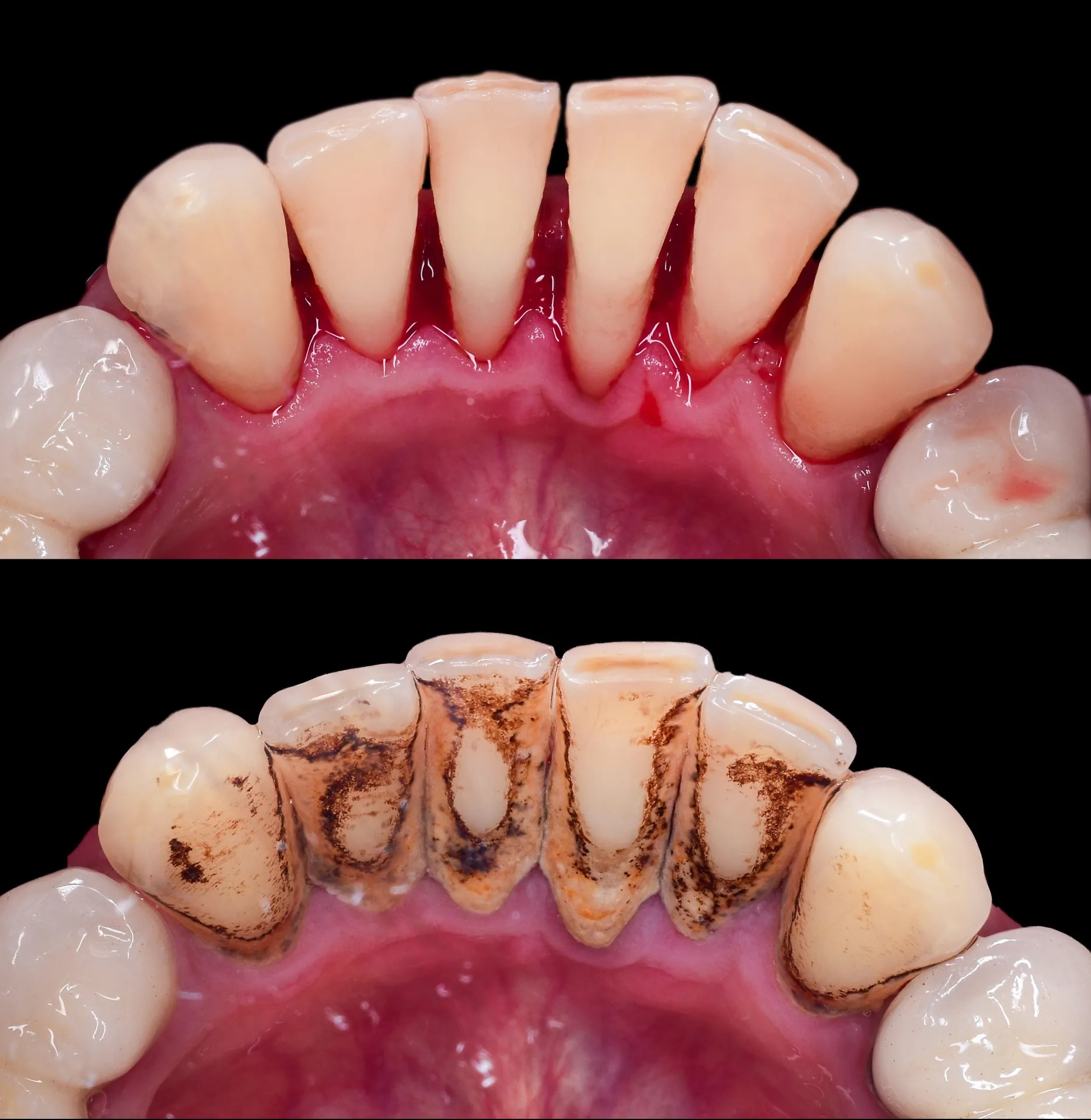 Mantenimiento periodontal y revisiones en Madrid