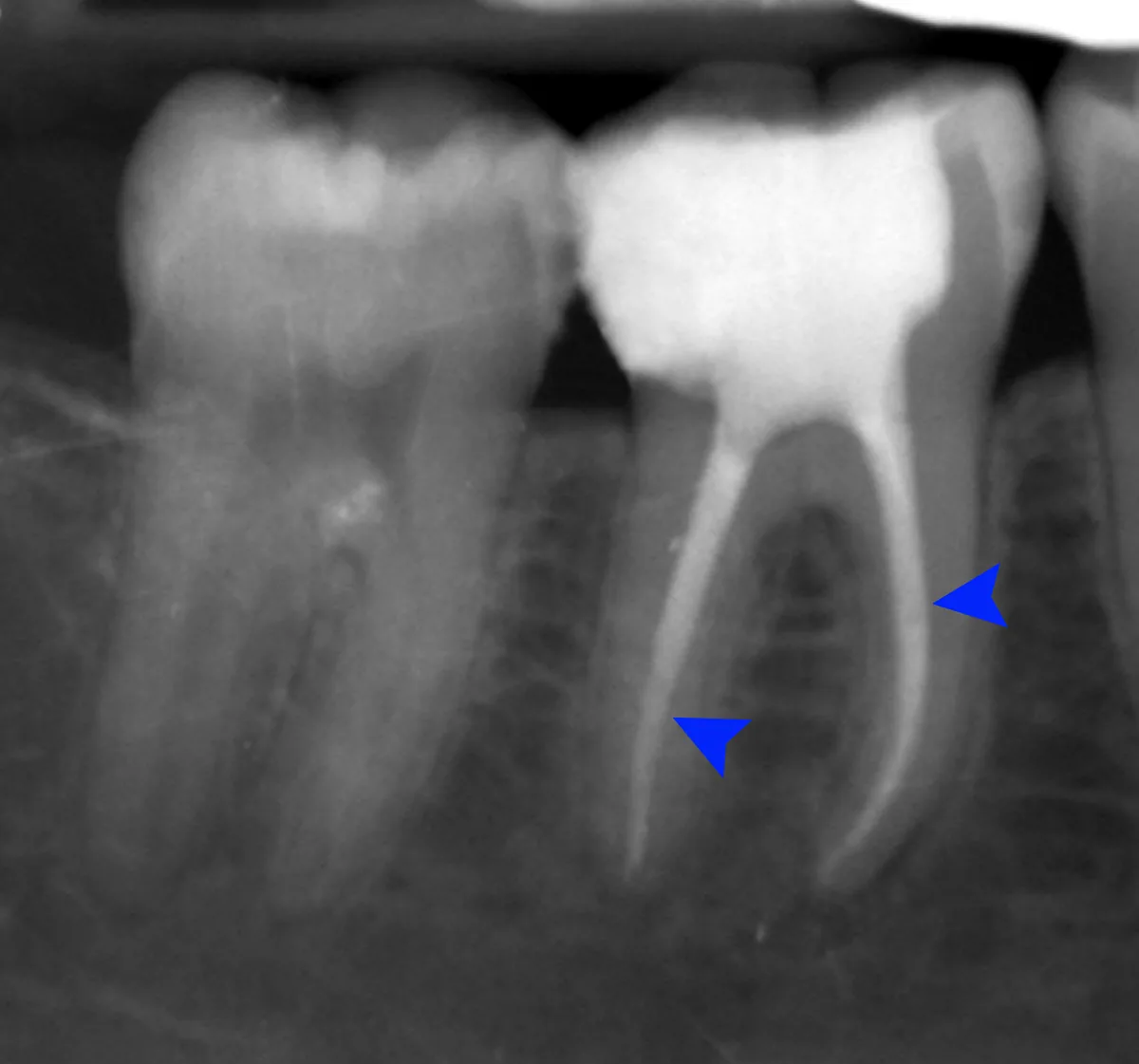 Radiografía periapical de tratamiento de conductos